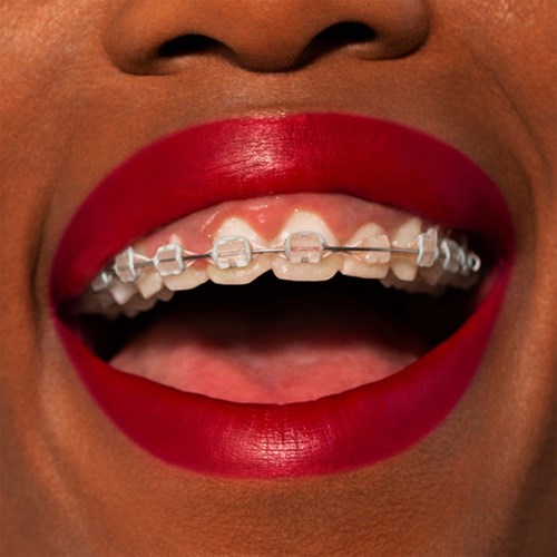 Close-up of a mouth with red lipstick and braces on teeth.