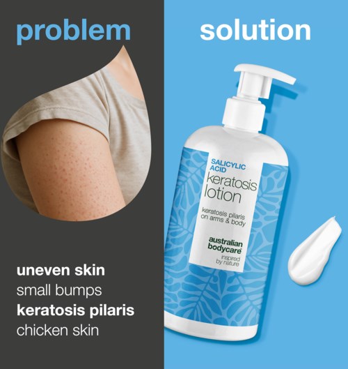 Shows skin with bumps and rough patches next to a bottle of lotion designed for keratosis pilaris.