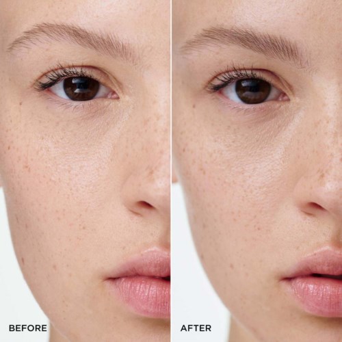 Sidobild av en ung kvinnas ansikte före och efter behandling med klar hud. Färre freckles och slätare hud i efterbilden.