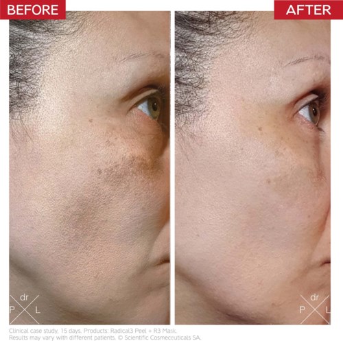 Пилинг для лица Dr. Levy Skin Reset Treatments Radical3 Reboot Pro Peel обновляющий, 50 мл — фото 3