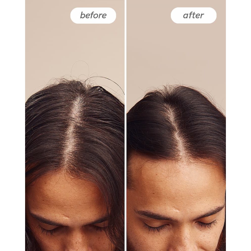 Hairlust Instant Relief Dandruff Shampoo 200 ml (zdjęcie 6)