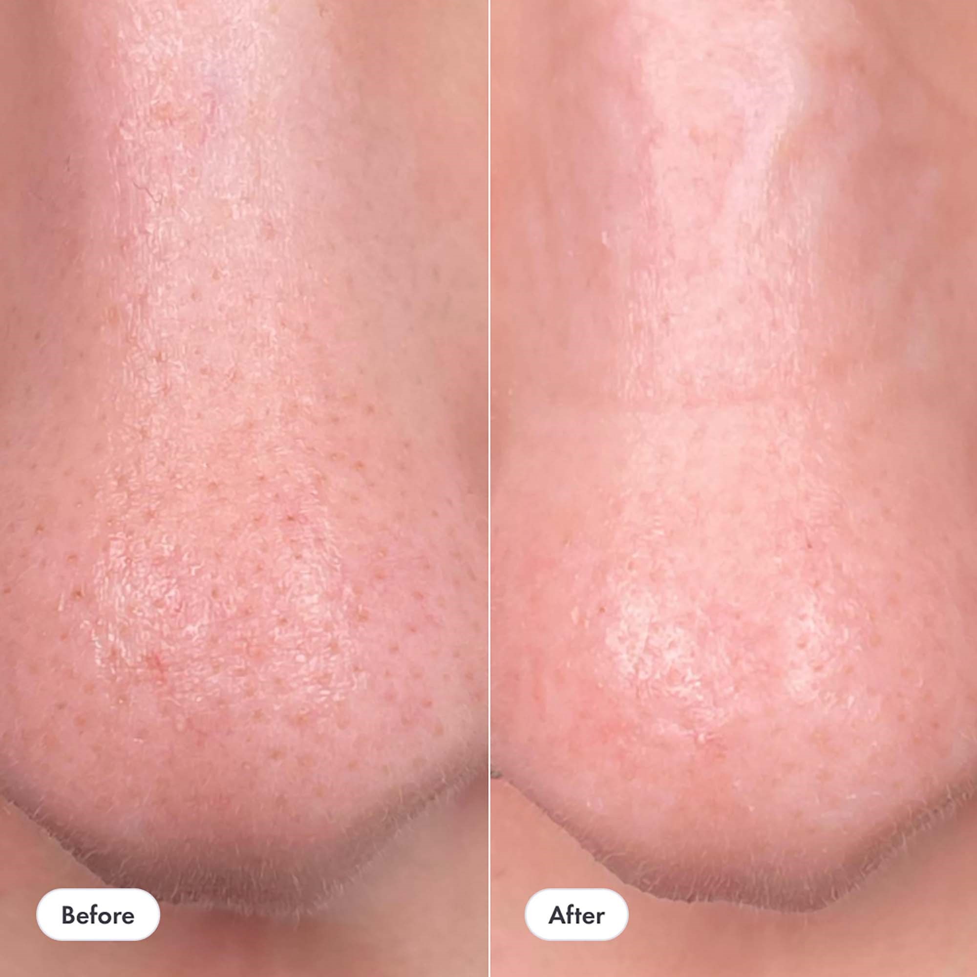 Hero Nose Patch (obrázok 6)