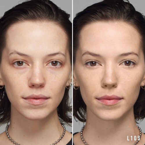 A side-by-side comparison of a woman's face shows clearer skin and fewer spots after treatment.