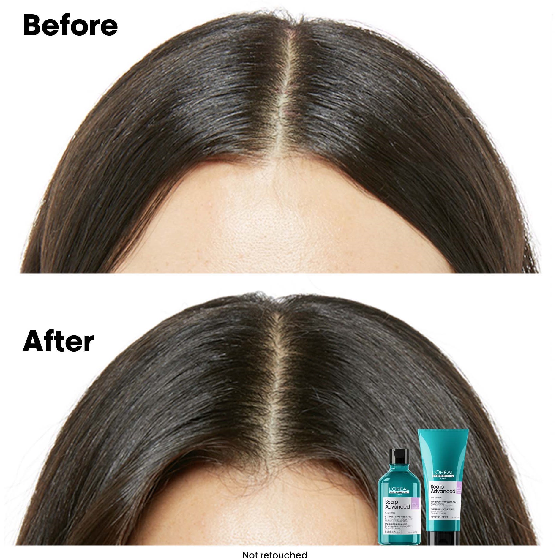 Alternativ bild 1 för L'Oréal Professionnel Scalp Advanced Serie Expert Professional Treatme