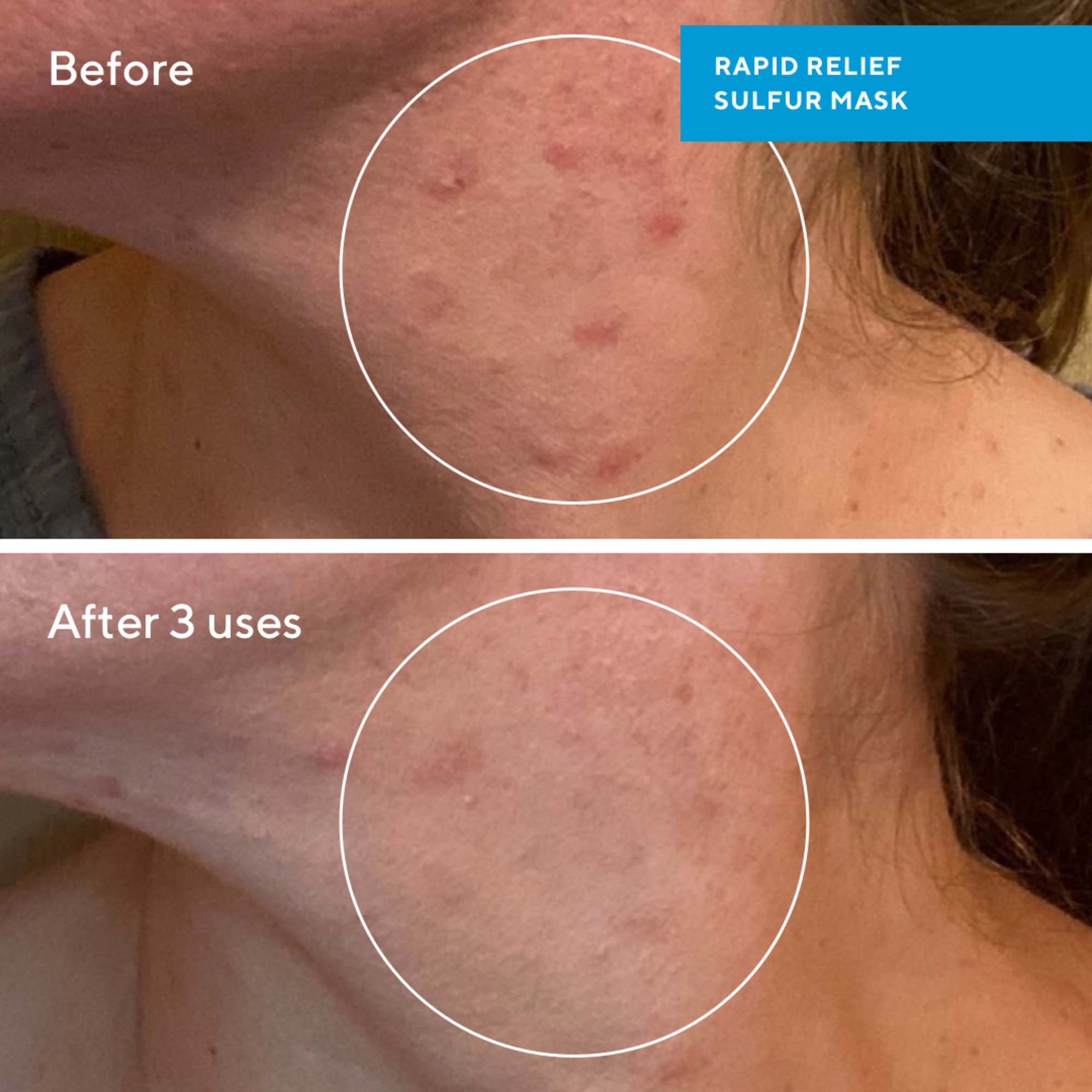 Murad Blemish Control Rapid Relief Sulfur Mask 75 ml (obrázok 4)