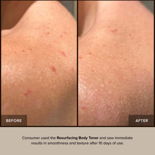 A side-by-side comparison showing skin before and after using Resurfacing Body Toner. Skin appears smoother and clearer after treatment.