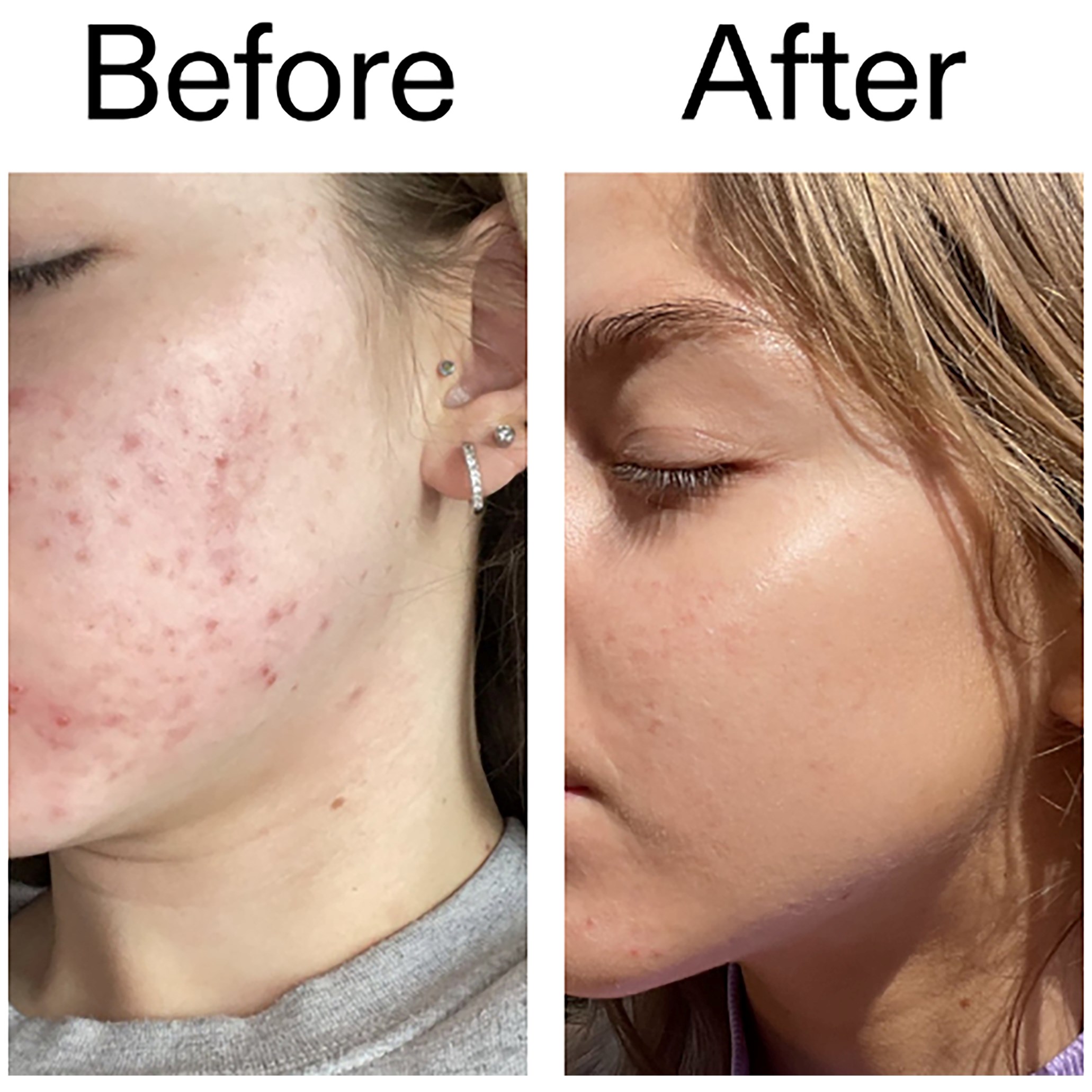 The Inkey List Beta Hydroxy Acid Serum 30 ml (obrázok 4)