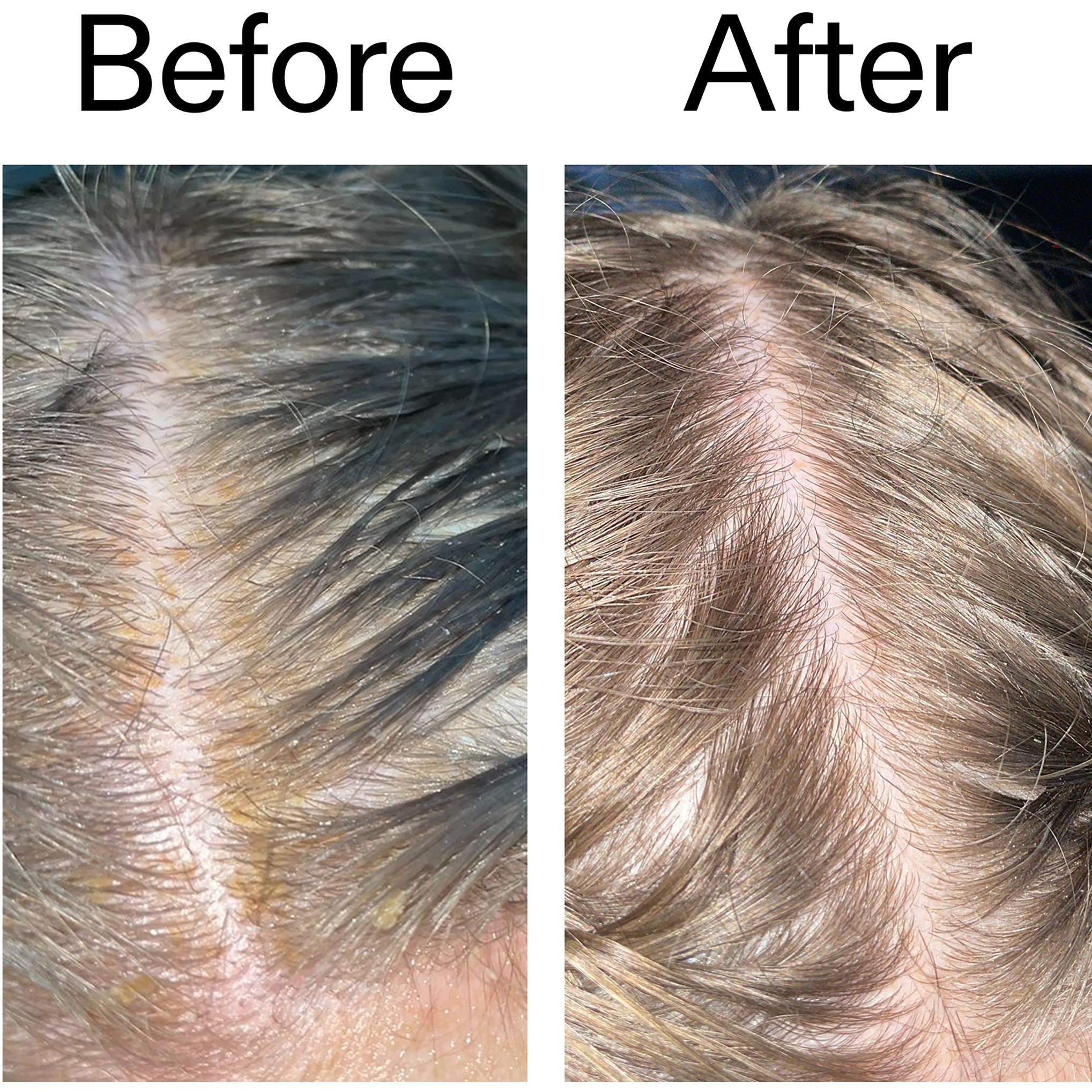 The Inkey List Salicylic Acid Exfoliating Scalp Treatment 150 ml (obrázok 8)
