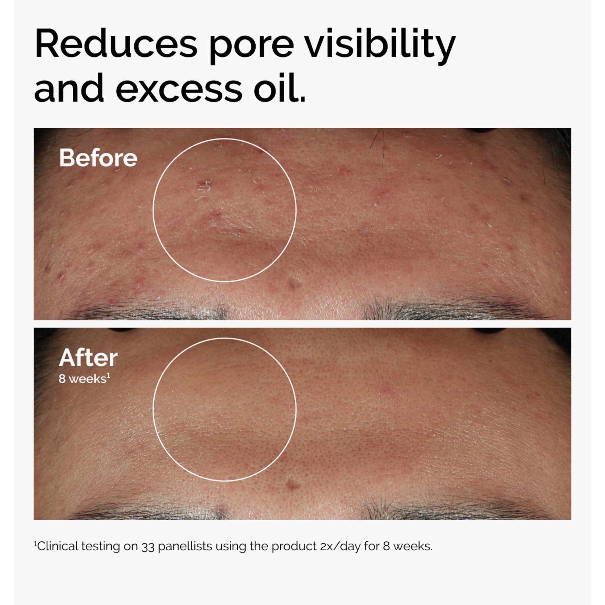 The Ordinary Niacinamide 10% + Zinc 1% - Serum z niacynamidem i cynkie (obrázok 3)