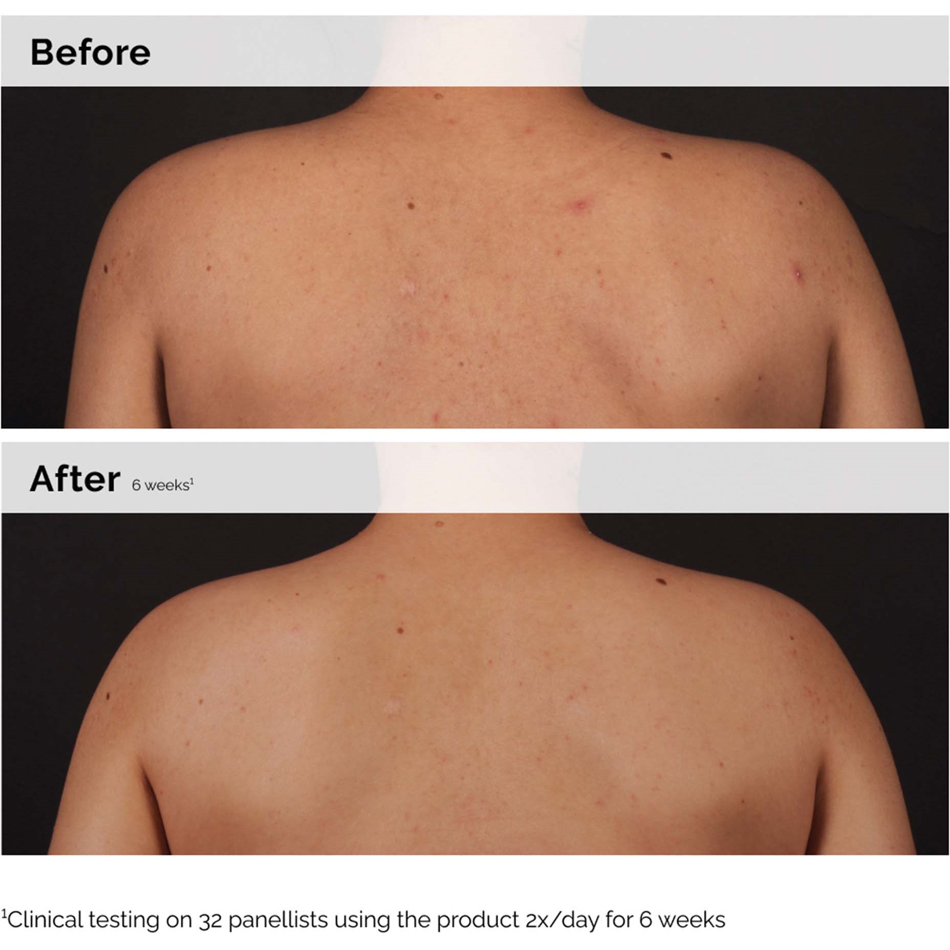 The Ordinary Salicylic Acid 0.5% Body Serum 240 ml (obrázok 3)