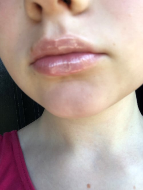 Accutane Wie Zu Kaufen